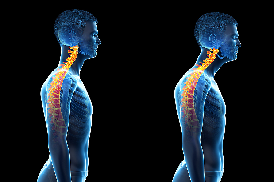 Forward Head Posture