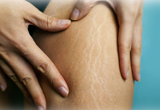 What is cellulite